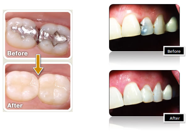 fillings before and after